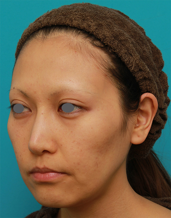 症例写真,ミディアムフェイスリフトで頬のたるみをリフトアップさせた20代後半女性の症例写真の術前術後画像,Before,ba_mediumlift16_b.jpg