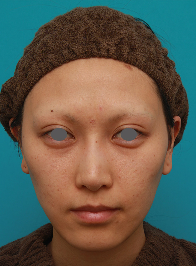 ミディアムフェイスリフト,ミディアムフェイスリフトで頬のたるみをリフトアップさせた20代後半女性の症例写真の術前術後画像,4ヶ月後,mainpic_mediumlift04d.jpg