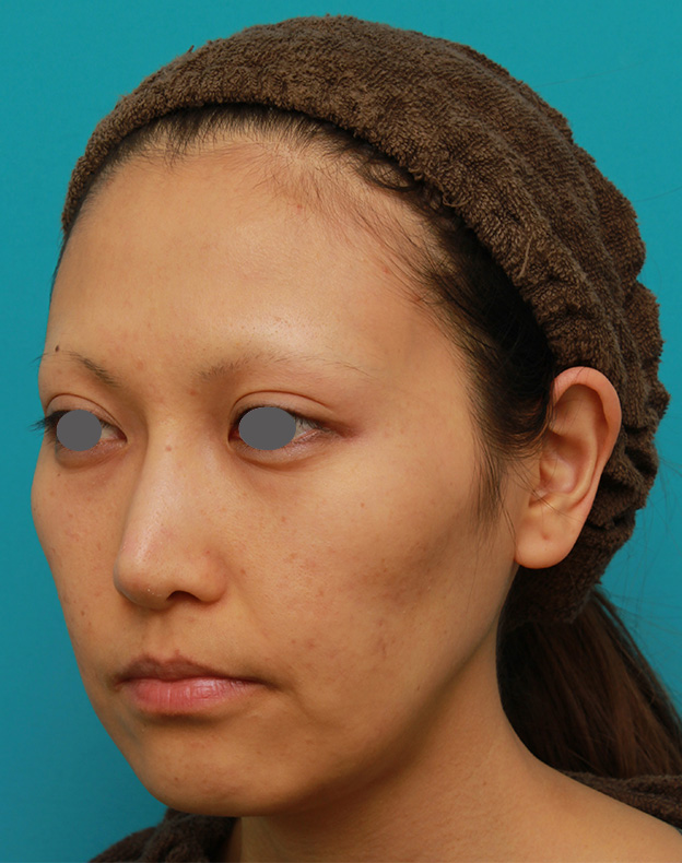 ミディアムフェイスリフト,ミディアムフェイスリフトで頬のたるみをリフトアップさせた20代後半女性の症例写真の術前術後画像,手術前,mainpic_mediumlift04e.jpg