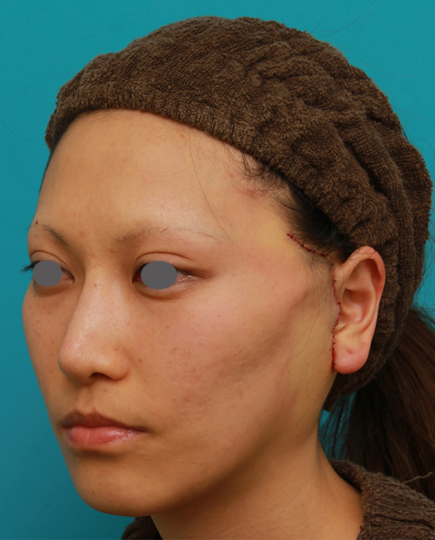 症例写真,ミディアムフェイスリフトで頬のたるみをリフトアップさせた20代後半女性の症例写真の術前術後画像,手術直後,mainpic_mediumlift04f.jpg