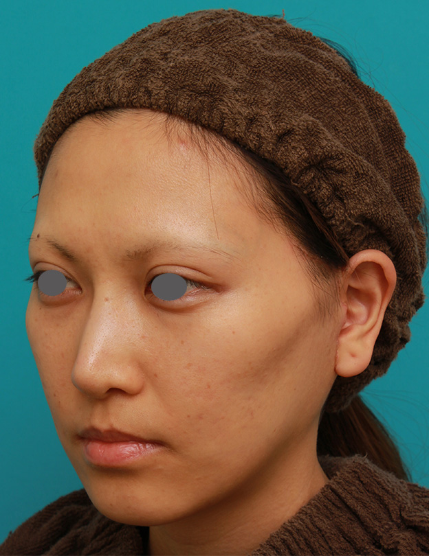 ミディアムフェイスリフト,ミディアムフェイスリフトで頬のたるみをリフトアップさせた20代後半女性の症例写真の術前術後画像,1週間後,mainpic_mediumlift04g.jpg