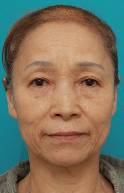 ミニフェイスリフト（頬のたるみ取り）,60代女性に行ったミニフェイスリフト（頬のたるみ取り）症例写真,手術前,ba_minilift_pic15a.jpg