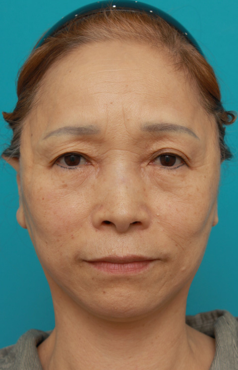 ミニフェイスリフト（頬のたるみ取り）,60代女性に行ったミニフェイスリフト（頬のたるみ取り）症例写真,手術直後,ba_minilift_pic15b.jpg
