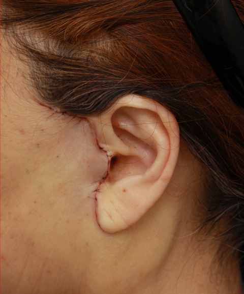 ミニフェイスリフト（頬のたるみ取り）,60代女性に行ったミニフェイスリフト（頬のたるみ取り）症例写真,手術直後,ba_minilift_pic16b.jpg