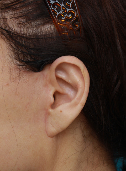 ミニフェイスリフト（頬のたるみ取り）,60代女性に行ったミニフェイスリフト（頬のたるみ取り）症例写真,1ヶ月後,ba_minilift_pic16c.jpg