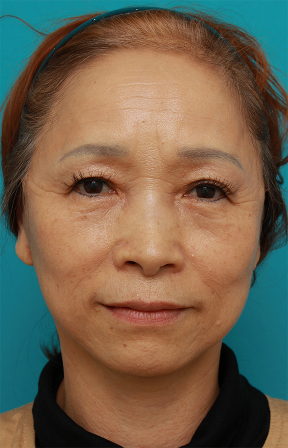 症例写真,60代女性に行ったミニフェイスリフト（頬のたるみ取り）症例写真,After（1ヶ月後）,ba_minilift_pic17a_b.jpg