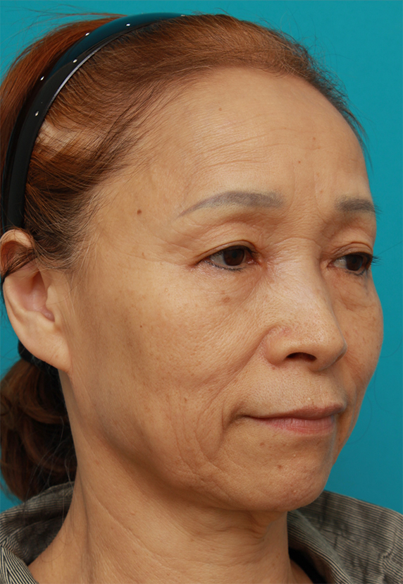 ミニフェイスリフト（頬のたるみ取り）,60代女性に行ったミニフェイスリフト（頬のたるみ取り）症例写真,Before,ba_minilift_pic17b_b.jpg