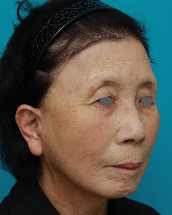 ミニフェイスリフト（頬のたるみ取り）,60代女性に行ったミニフェイスリフト（頬のたるみ取り）の症例写真,After,ba_minilift19_b.jpg