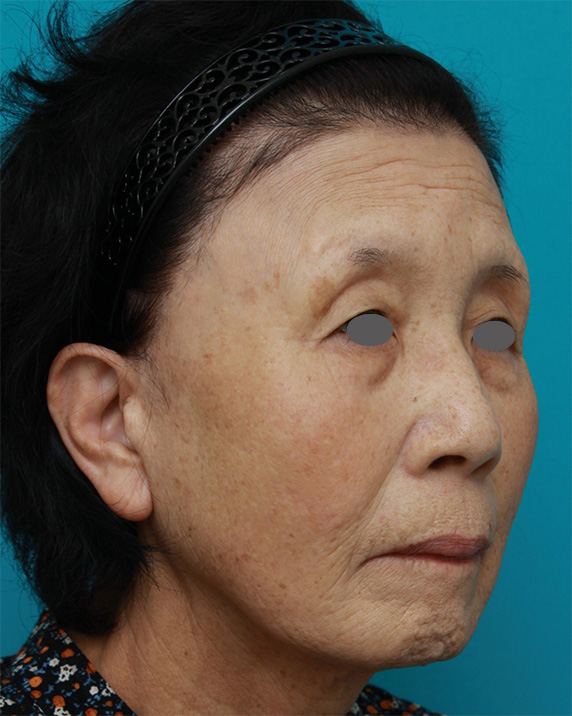 ミニフェイスリフト（頬のたるみ取り）,60代女性に行ったミニフェイスリフト（頬のたるみ取り）の症例写真,Before,ba_minilift19_b.jpg
