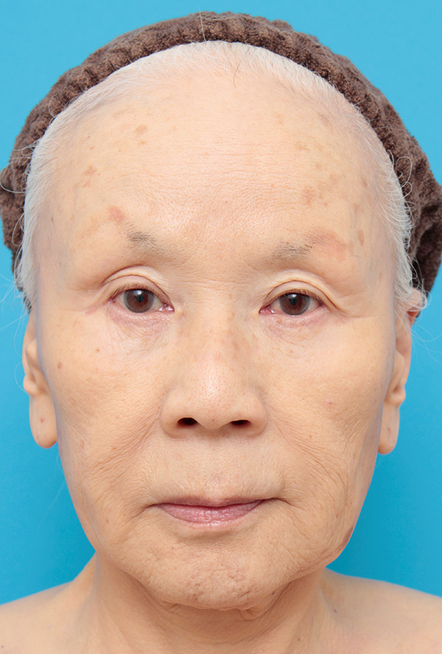 ミニフェイスリフト（頬のたるみ取り）,70代女性にミニフェイスリフト（頬のたるみ取り）を行った症例写真,手術前,mainpic_minilift02a.jpg