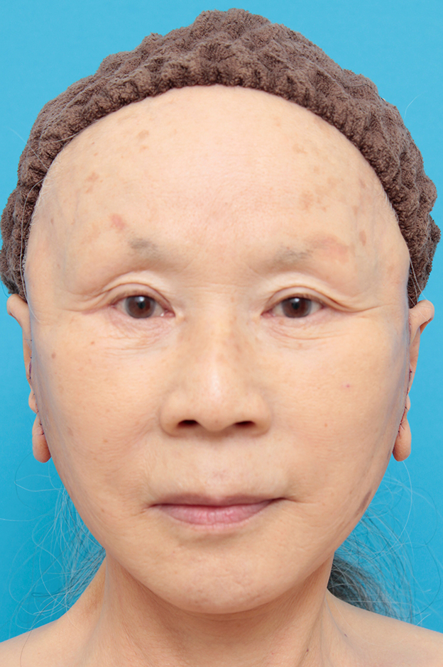 ミニフェイスリフト（頬のたるみ取り）,70代女性にミニフェイスリフト（頬のたるみ取り）を行った症例写真,手術直後,mainpic_minilift02b.jpg