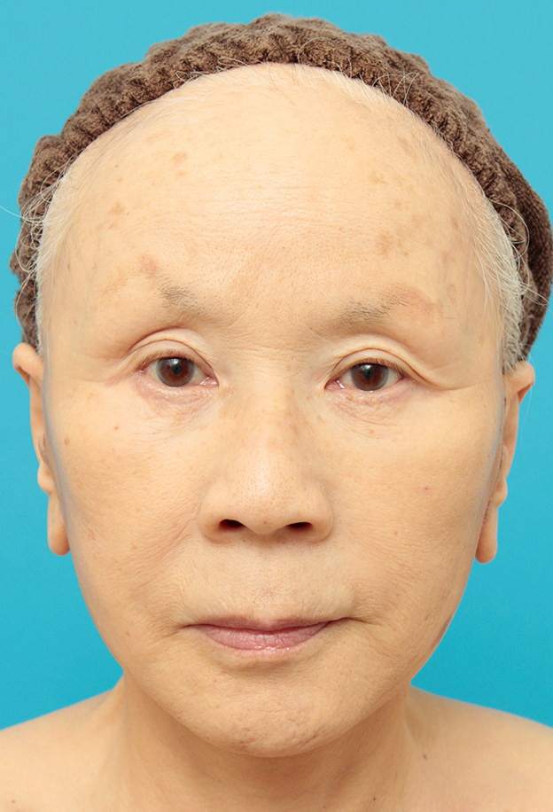 ミニフェイスリフト（頬のたるみ取り）,70代女性にミニフェイスリフト（頬のたるみ取り）を行った症例写真,1週間後,mainpic_minilift02c.jpg