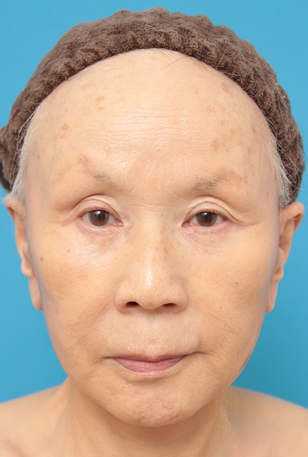 ミニフェイスリフト（頬のたるみ取り）,70代女性にミニフェイスリフト（頬のたるみ取り）を行った症例写真,6ヶ月後,mainpic_minilift02d.jpg
