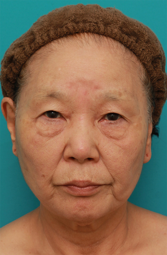 ミニフェイスリフト（頬のたるみ取り）,70代女性にミニフェイスリフト（頬のたるみ取り）を行い、頬や首のたるみを改善させた症例　術前術後画像,After（6ヶ月後）,ba_minilift21_b.jpg