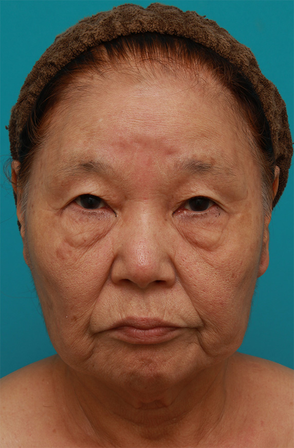 ミニフェイスリフト（頬のたるみ取り）,70代女性にミニフェイスリフト（頬のたるみ取り）を行い、頬や首のたるみを改善させた症例　術前術後画像,Before,ba_minilift21_b.jpg