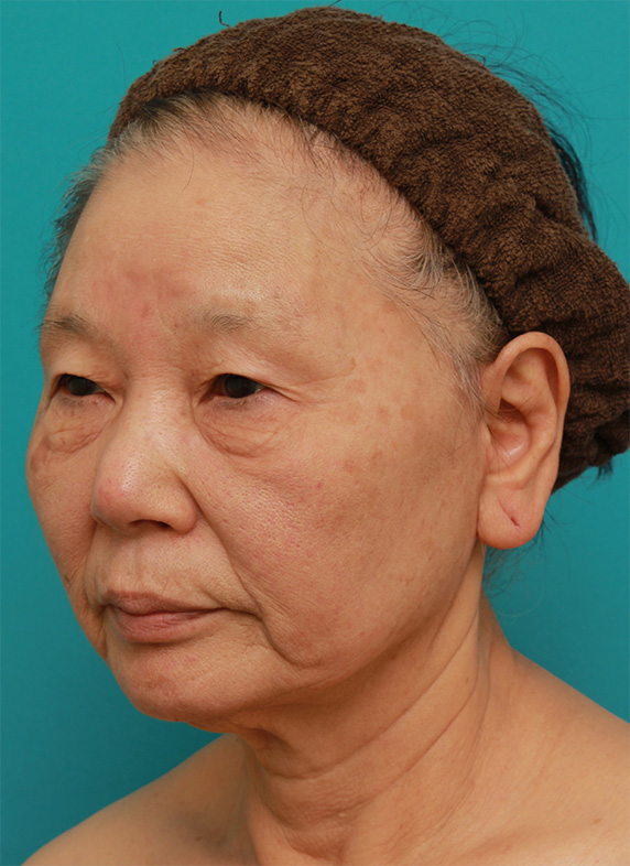 ミニフェイスリフト（頬のたるみ取り）,70代女性にミニフェイスリフト（頬のたるみ取り）を行い、頬や首のたるみを改善させた症例　術前術後画像,After（6ヶ月後）,ba_minilift22_b.jpg