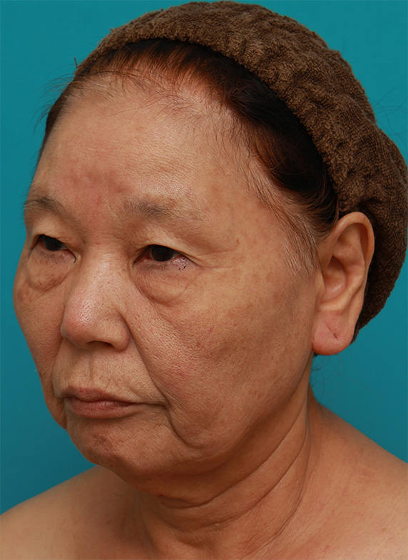 ミニフェイスリフト（頬のたるみ取り）,70代女性にミニフェイスリフト（頬のたるみ取り）を行い、頬や首のたるみを改善させた症例　術前術後画像,Before,ba_minilift22_b.jpg