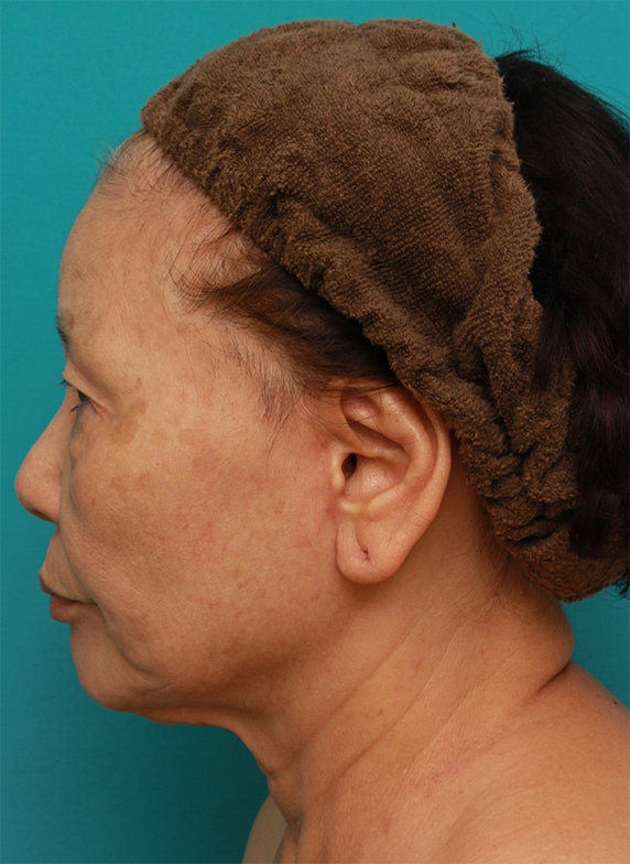 ミニフェイスリフト（頬のたるみ取り）,70代女性にミニフェイスリフト（頬のたるみ取り）を行い、頬や首のたるみを改善させた症例　術前術後画像,After（6ヶ月後）,ba_minilift23_b.jpg