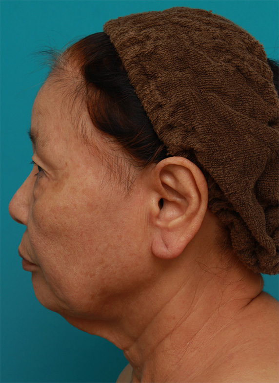 ミニフェイスリフト（頬のたるみ取り）,70代女性にミニフェイスリフト（頬のたるみ取り）を行い、頬や首のたるみを改善させた症例　術前術後画像,Before,ba_minilift23_b.jpg