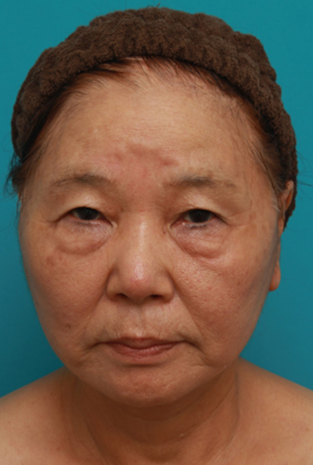 ミニフェイスリフト（頬のたるみ取り）,70代女性にミニフェイスリフト（頬のたるみ取り）を行い、頬や首のたるみを改善させた症例　術前術後画像,1週間後,mainpic_minilift03c.jpg