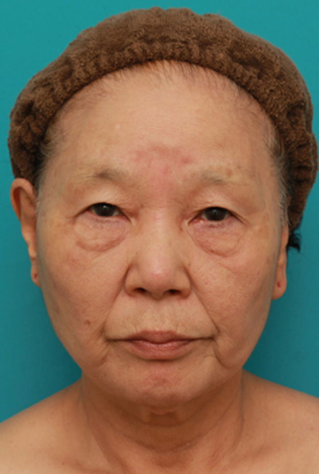 ミニフェイスリフト（頬のたるみ取り）,70代女性にミニフェイスリフト（頬のたるみ取り）を行い、頬や首のたるみを改善させた症例　術前術後画像,6ヶ月後,mainpic_minilift03d.jpg