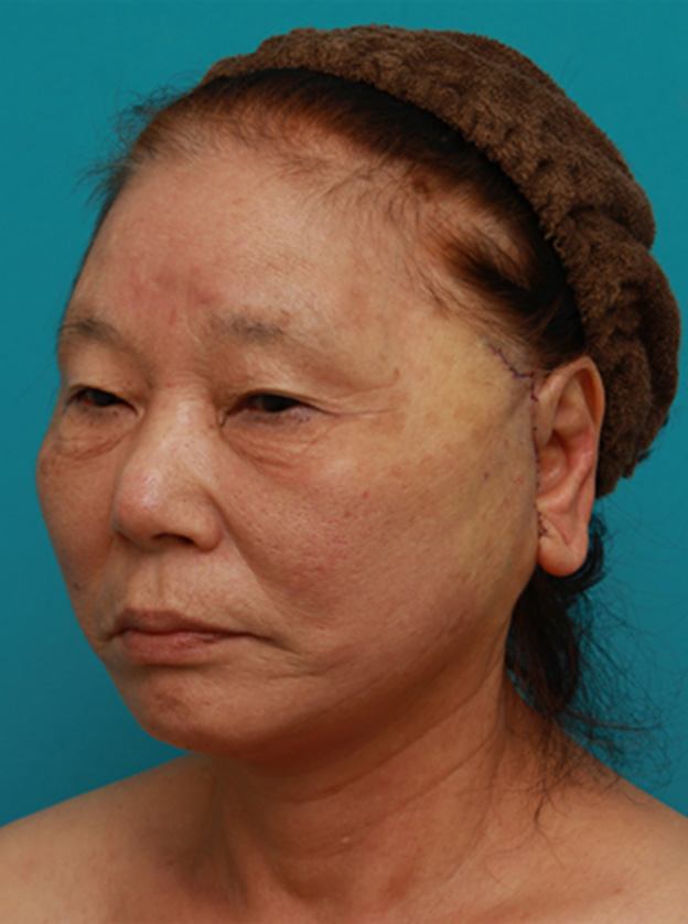 ミニフェイスリフト（頬のたるみ取り）,70代女性にミニフェイスリフト（頬のたるみ取り）を行い、頬や首のたるみを改善させた症例　術前術後画像,手術直後,mainpic_minilift03f.jpg