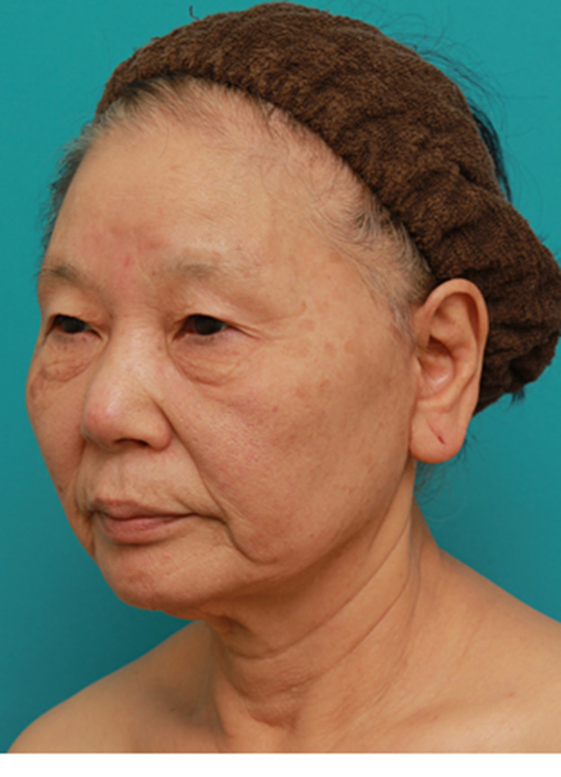 ミニフェイスリフト（頬のたるみ取り）,70代女性にミニフェイスリフト（頬のたるみ取り）を行い、頬や首のたるみを改善させた症例　術前術後画像,6ヶ月後,mainpic_minilift03h.jpg