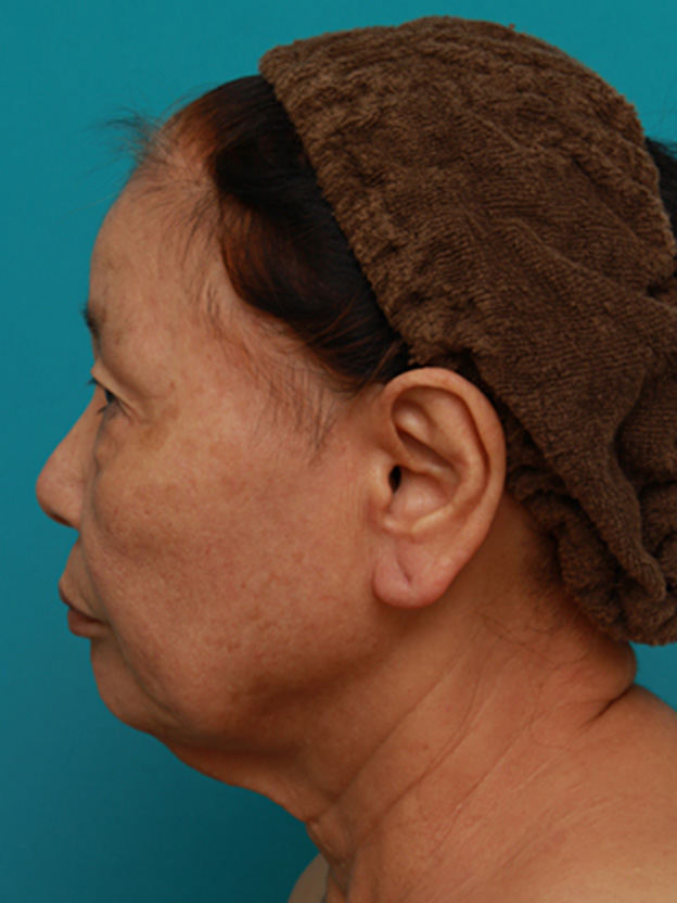 ミニフェイスリフト（頬のたるみ取り）,70代女性にミニフェイスリフト（頬のたるみ取り）を行い、頬や首のたるみを改善させた症例　術前術後画像,手術前,mainpic_minilift03i.jpg
