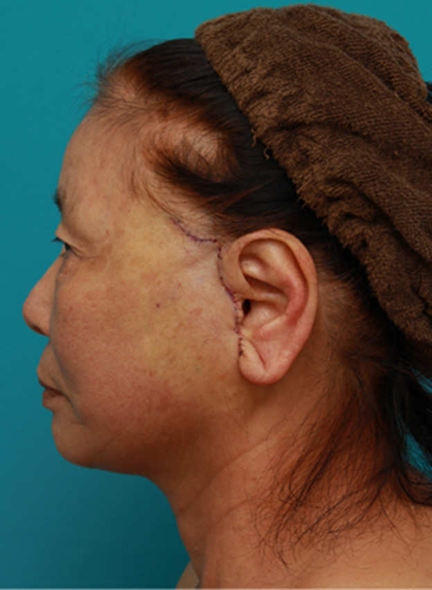 ミニフェイスリフト（頬のたるみ取り）,70代女性にミニフェイスリフト（頬のたるみ取り）を行い、頬や首のたるみを改善させた症例　術前術後画像,手術直後,mainpic_minilift03j.jpg