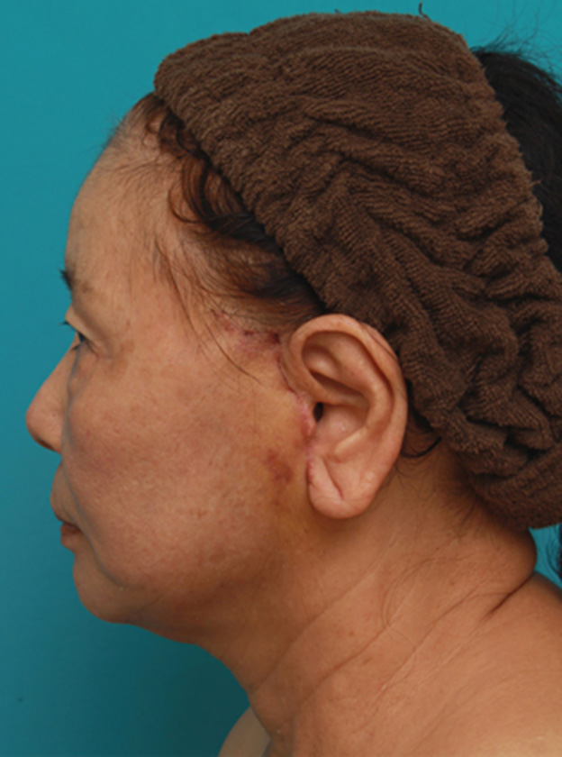 ミニフェイスリフト（頬のたるみ取り）,70代女性にミニフェイスリフト（頬のたるみ取り）を行い、頬や首のたるみを改善させた症例　術前術後画像,1週間後,mainpic_minilift03k.jpg