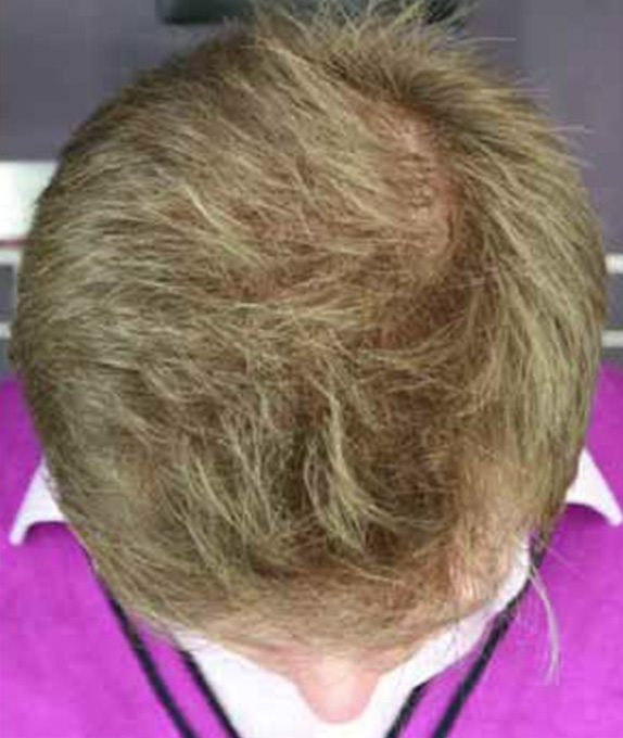 AGA治療（高須式メディカル育毛プログラム）,AGA治療（高須式メディカル育毛プログラム）の症例写真４　HARG療法を施術,After（2週間後　2回目施術後）,ba_aga_04_a01.jpg