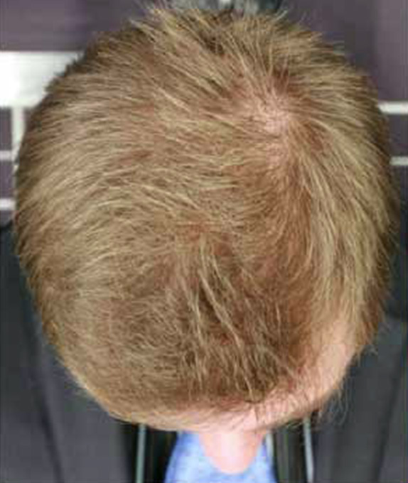 AGA治療（高須式メディカル育毛プログラム）の症例写真４　HARG療法を施術,Before,ba_aga_04_b.jpg