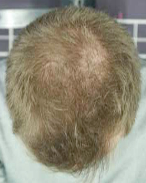 症例写真,AGA治療（高須式メディカル育毛プログラム）の症例写真４　HARG療法を施術,1週間後,mainpic_aga01b.jpg