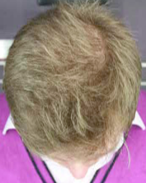 症例写真,AGA治療（高須式メディカル育毛プログラム）の症例写真４　HARG療法を施術,2週間後,mainpic_aga01c.jpg
