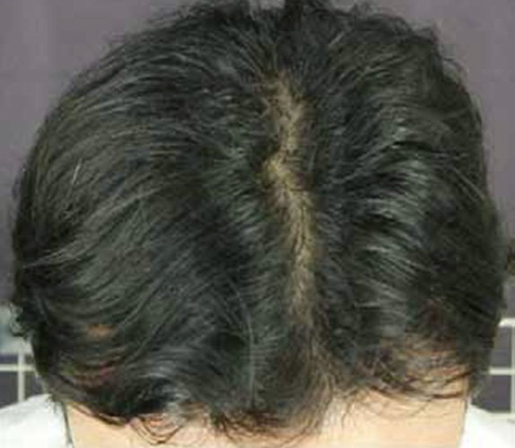 症例写真,AGA治療（高須式メディカル育毛プログラム）の症例写真５,After（1ヶ月後　3回目施術後）,ba_aga_05_b.jpg