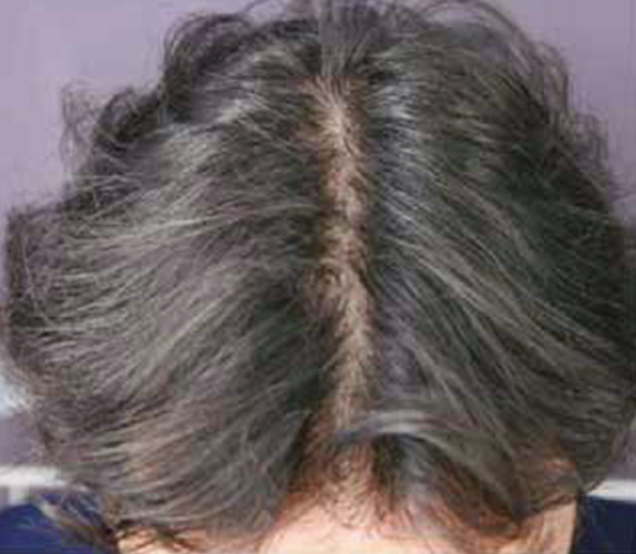 AGA治療（高須式メディカル育毛プログラム）,AGA治療（高須式メディカル育毛プログラム）の症例写真５,Before,ba_aga_05_b.jpg