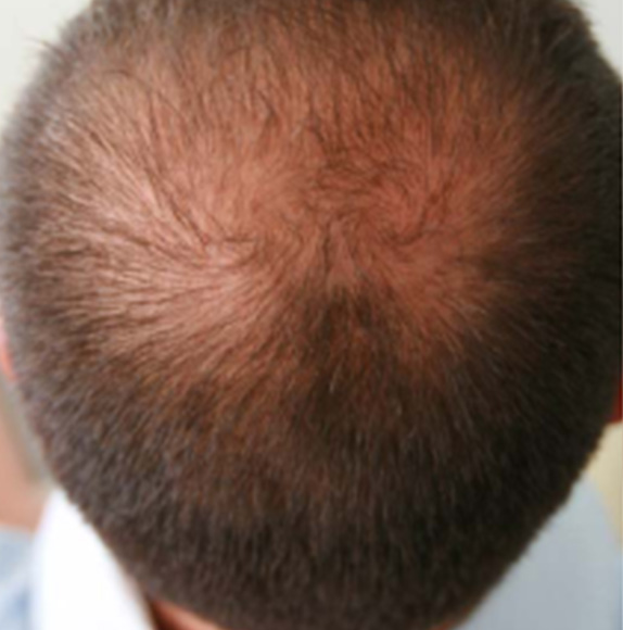 AGA治療（高須式メディカル育毛プログラム）の症例写真１,Before,ba_aga_01_b.jpg
