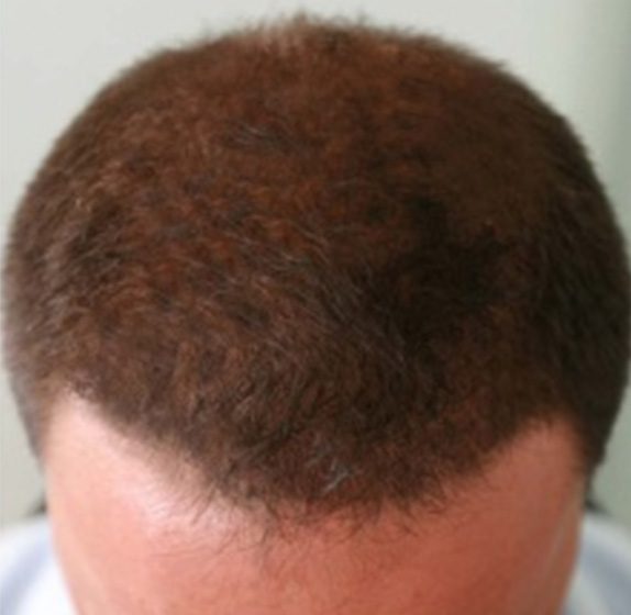 AGA治療（高須式メディカル育毛プログラム）,AGA治療（高須式メディカル育毛プログラム）の症例写真１,After,ba_aga_02_b.jpg