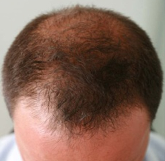 AGA治療（高須式メディカル育毛プログラム）,AGA治療（高須式メディカル育毛プログラム）の症例写真１,Before,ba_aga_02_b.jpg