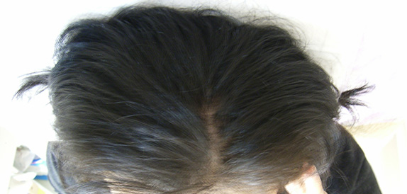 AGA治療（高須式メディカル育毛プログラム）,女性の薄毛治療,女性の薄毛治療（HARG療法）の症例 HARG療法を3回施術,After,ba_aga_27_a01.jpg