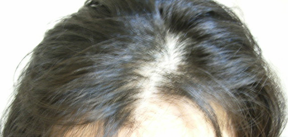 女性の薄毛治療,女性の薄毛治療（HARG療法）の症例 HARG療法を3回施術,Before,ba_aga_27_b.jpg