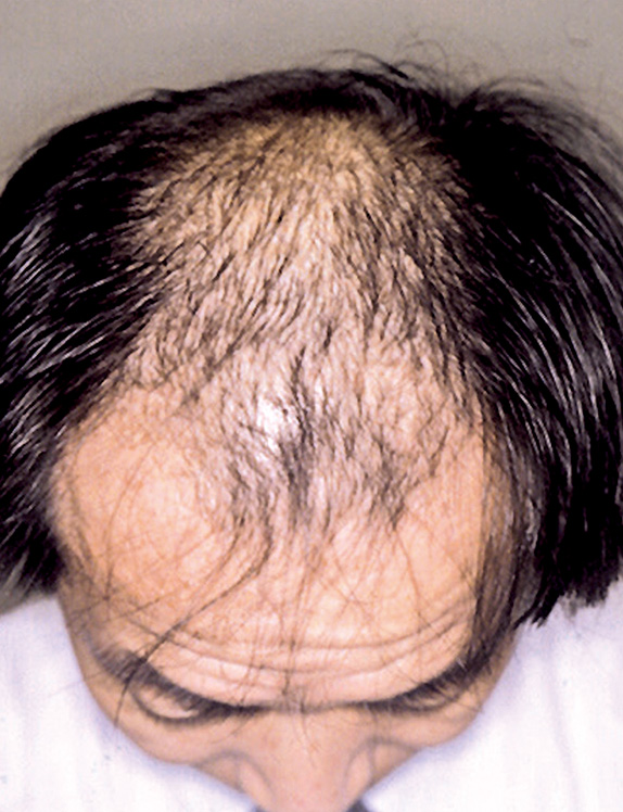 医療植毛,医療植毛 後退してきた生え際が気になる50代の男性の症例,Before,ba_hair08_b.jpg