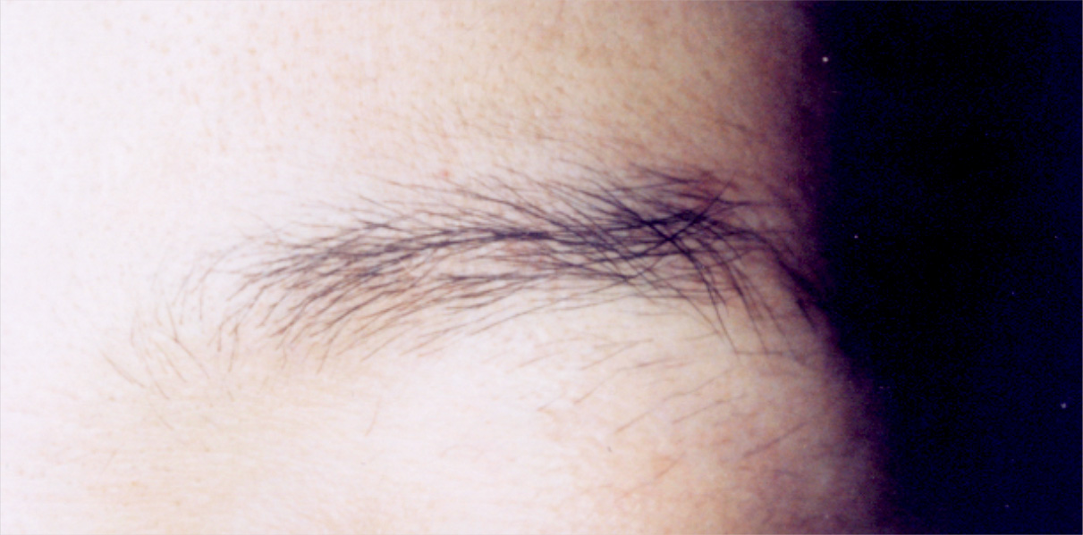 まつ毛、眉毛の植毛,眉毛の植毛の症例写真,Before,ba_hair04_b.jpg