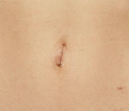症例写真,非常に難しいへそヘルニアの手術の症例写真,After（6ヶ月後）,ba_navel_11_b.jpg
