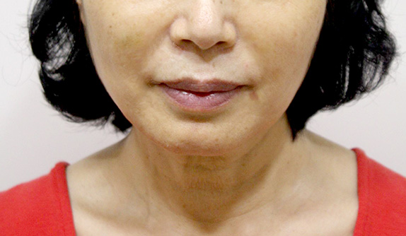 イタリアンリフト,イタリアンリフトの症例写真 顔のたるみを気にして来院した女性,After（1ヶ月後）,ba_italian_pic12_a01.jpg