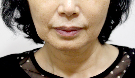 症例写真,イタリアンリフトの症例写真 顔のたるみを気にして来院した女性,Before,ba_italian_pic12_b.jpg