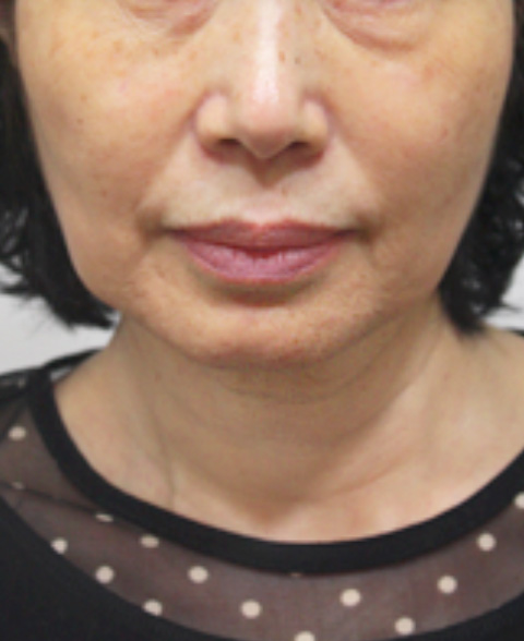 イタリアンリフト,イタリアンリフトの症例写真 顔のたるみを気にして来院した女性,施術前,mainpic_italian02a.jpg