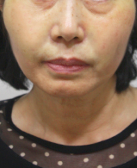 症例写真,イタリアンリフトの症例写真 顔のたるみを気にして来院した女性,施術直後,mainpic_italian02b.jpg