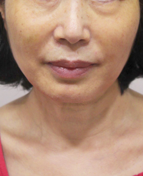 症例写真,イタリアンリフトの症例写真 顔のたるみを気にして来院した女性,1ヶ月後,mainpic_italian02c.jpg