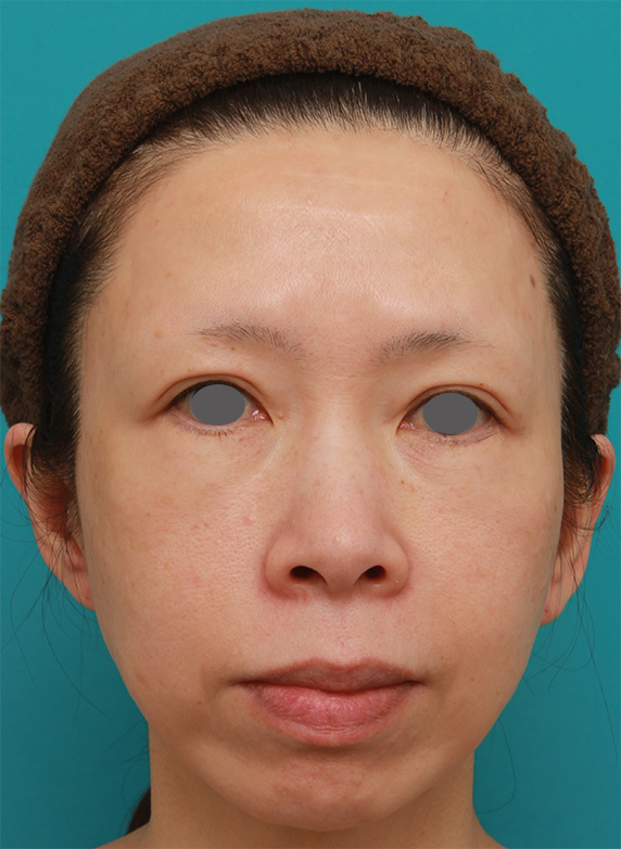 イタリアンリフト,イタリアンリフトで頬のたるみをリフトアップした50代女性の症例写真の術前術後画像,After（6ヶ月後）,ba_italian21_b.jpg